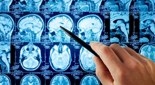 Les nanoparticules chargées de médicaments offrent une nouvelle approche pour traiter le cancer du cerveau