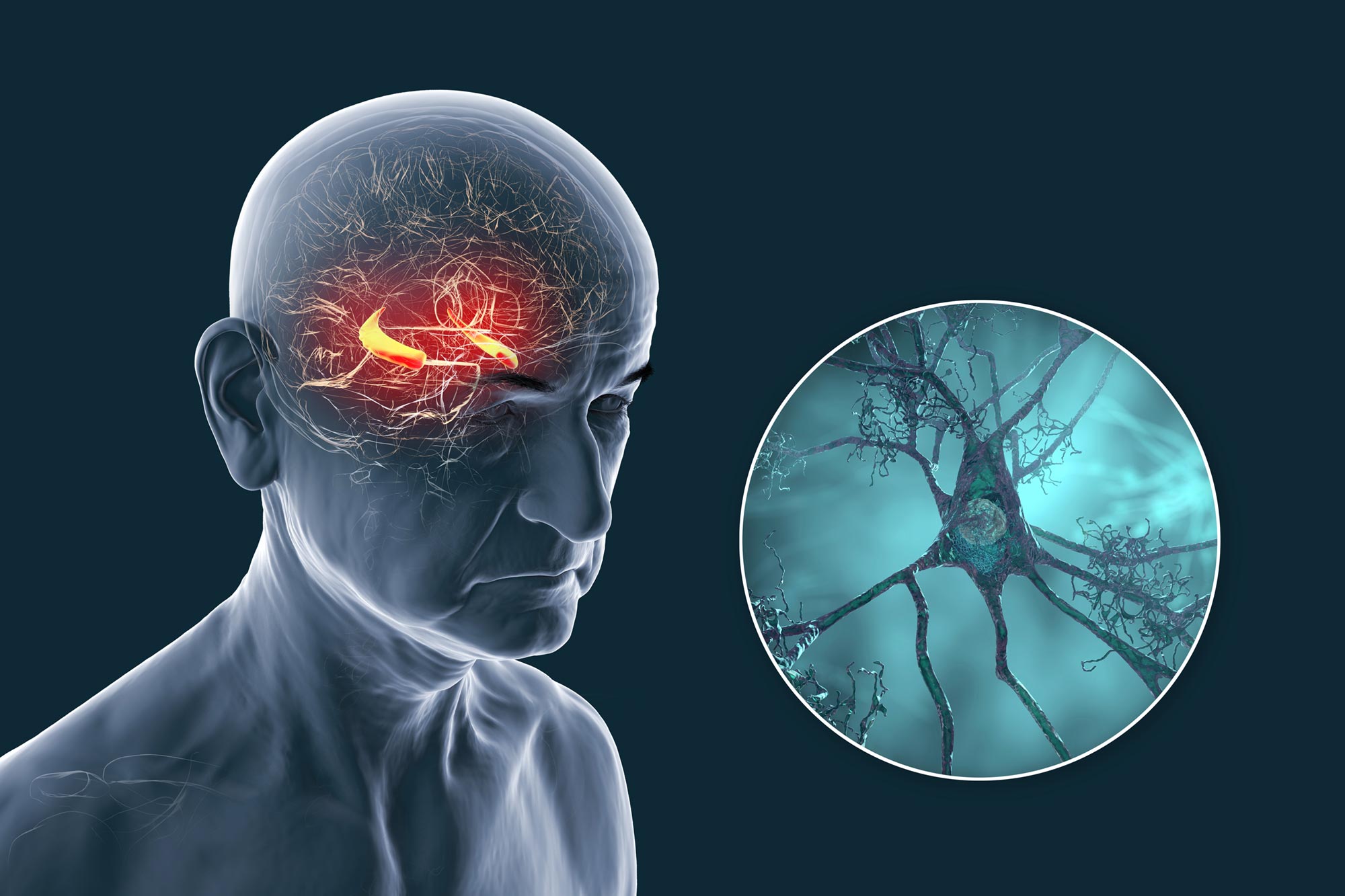 Une nouvelle étude remet en question les théories sur la maladie d’Alzheimer;: il ne s’agit pas seulement de plaques