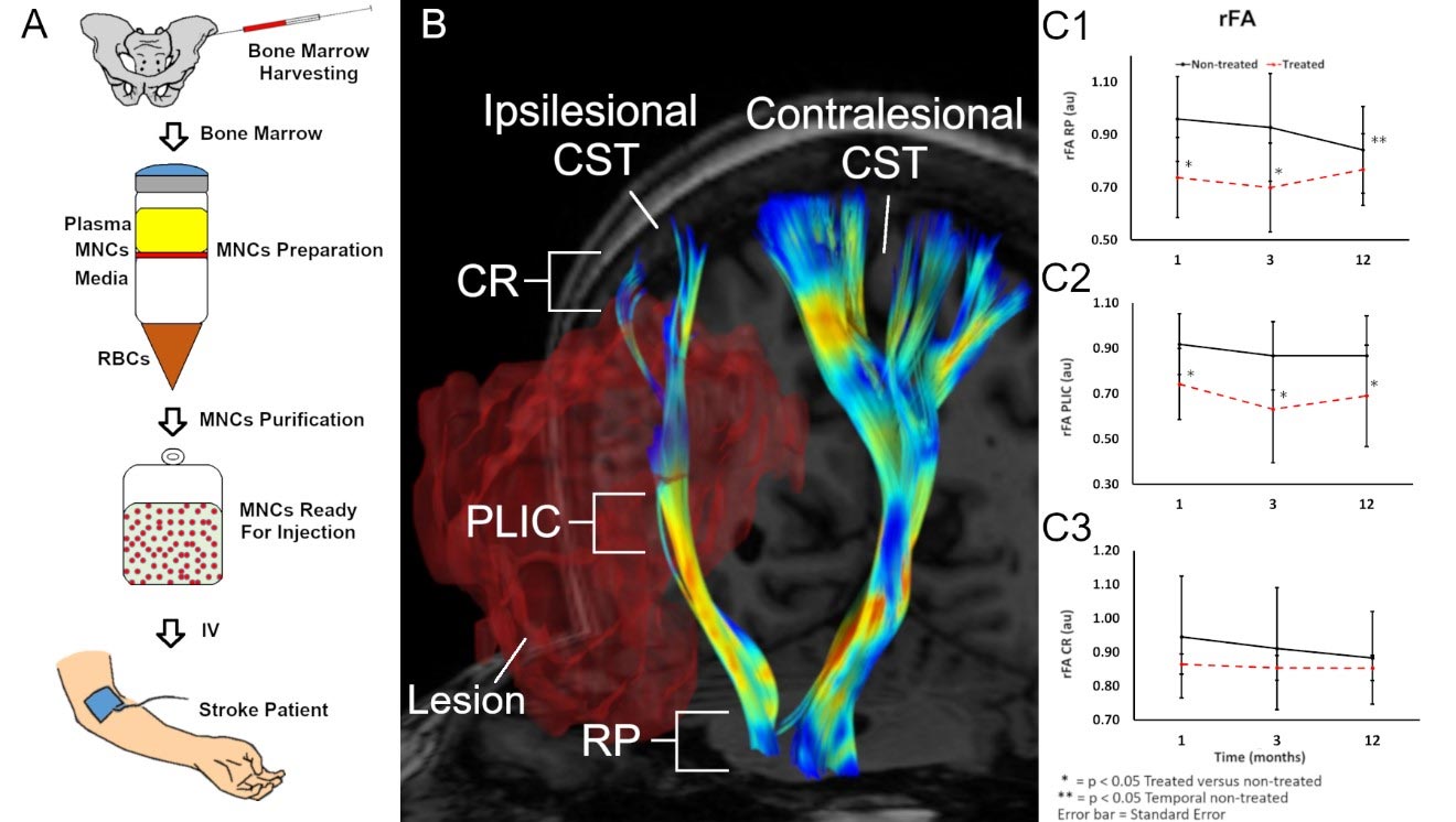 L'injection de cellules de moelle osseuse aide à guérir le cerveau après un AVC