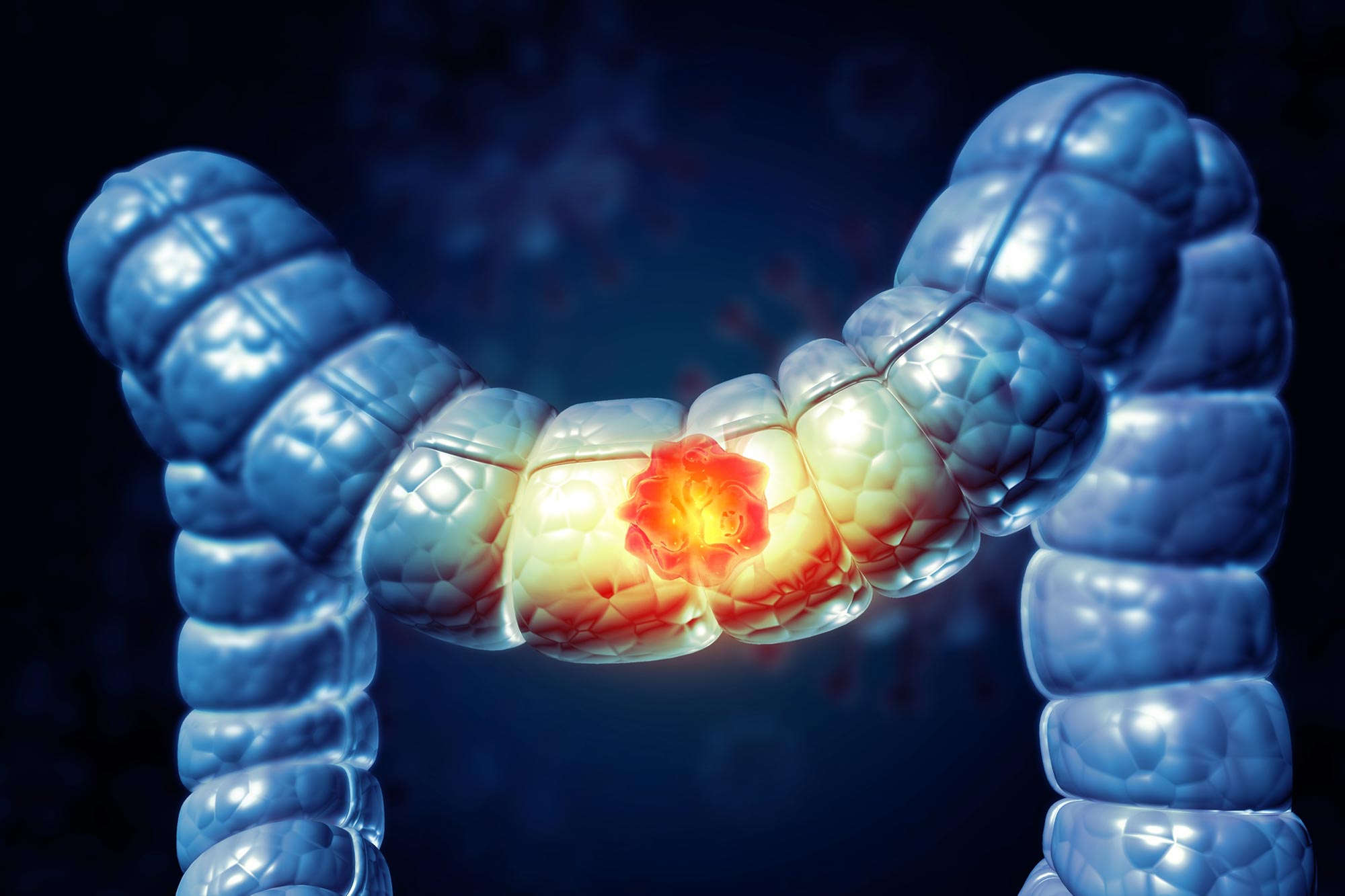 Des chercheurs résolvent le mystère de 15 ans derrière la toxine intestinale cancérigène
