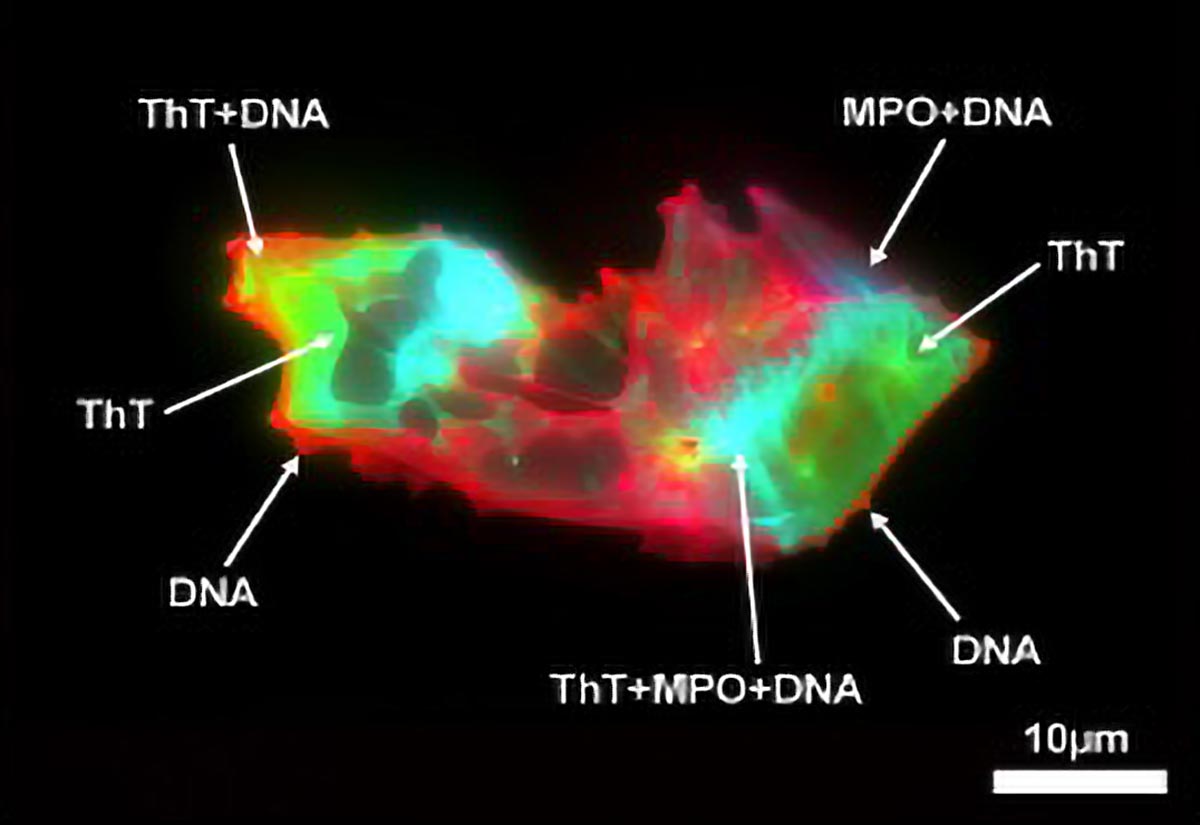 Des scientifiques découvrent un motif sanguin caché dans un long COVID