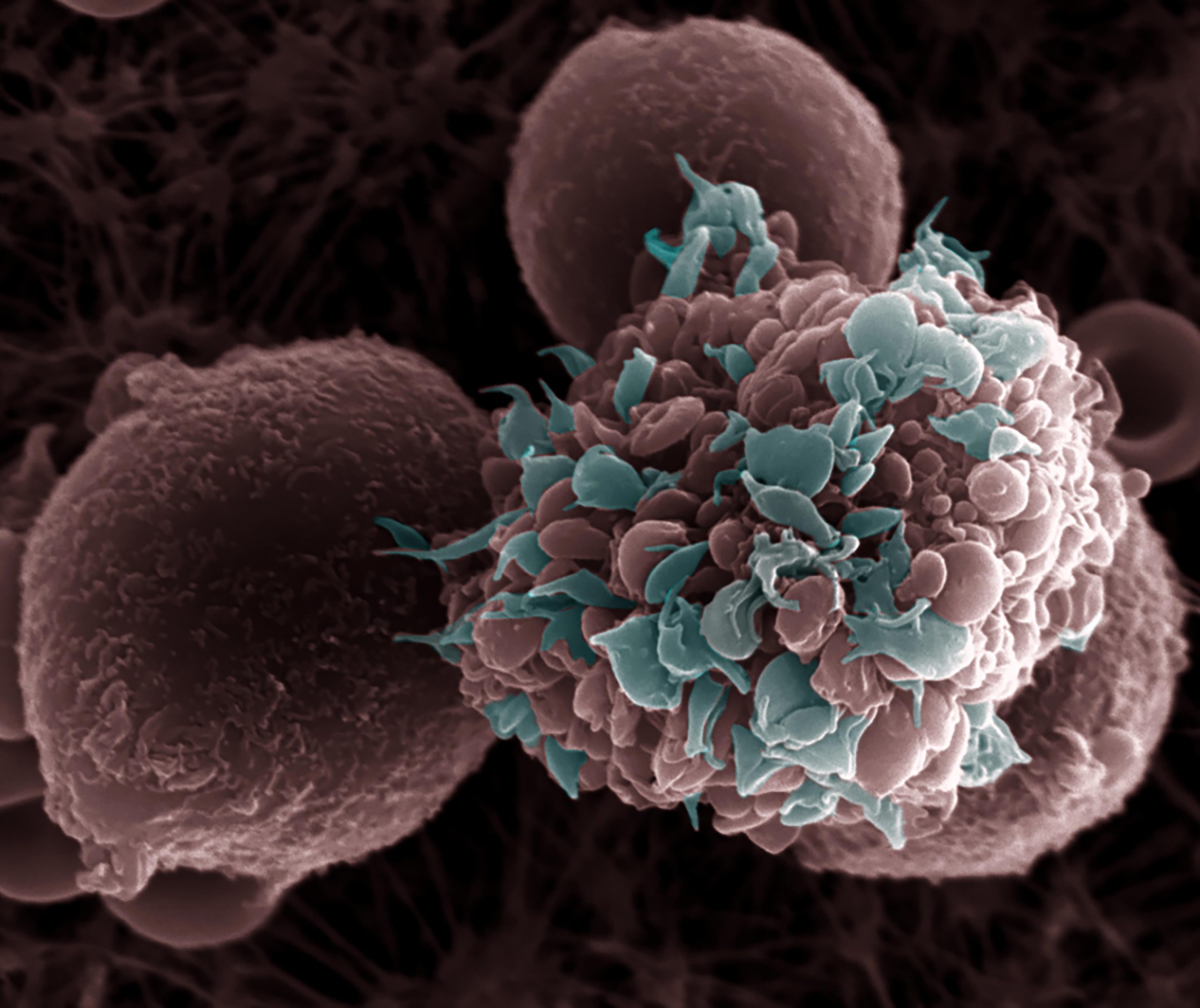 Comment l'obésité alimente la propagation du cancer du sein: une nouvelle étude révèle un lien alarmant